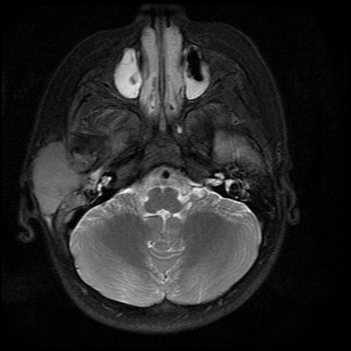 Multifocal Sporadic Burkitt’s Lymphoma Involving Temporal Bone and Parapharyngeal Space
