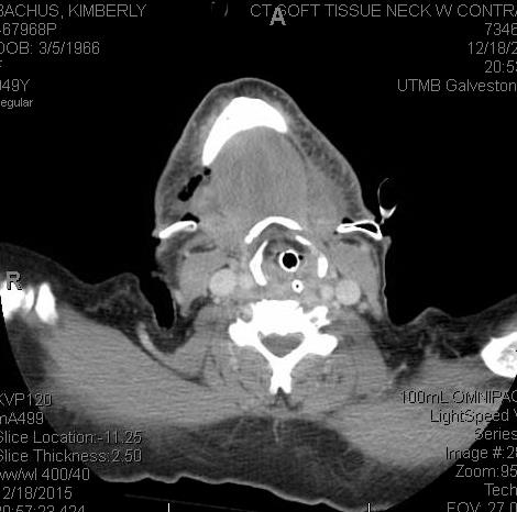 It’s Never Just a PTA: A Series of Deep Neck Infections with Literature Review