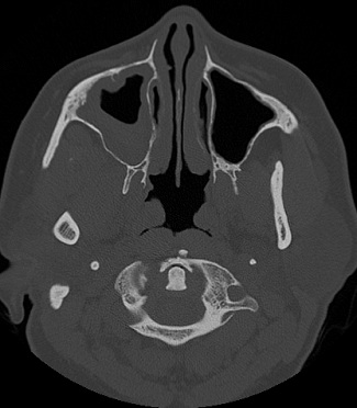 Bilateral Sinonasal Lymphoma in the Absence of a Solitary Lesion: Case Report and Review of the Literature