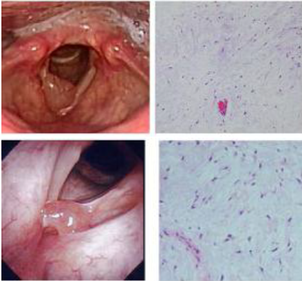 Two Cases of Laryngeal Myxoma Misdiagnosed as a Vocal Fold Polyp