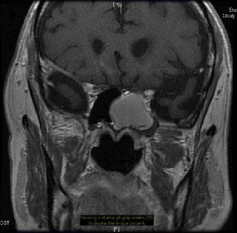 Incidence of Sphenoid Sinus Mucoceles after Endoscopic Transsphenoidal Approach with Sphenoid Obliteration