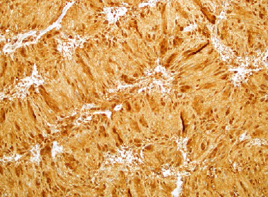 Frontoethmoidal Sinus Schwannoma Eroding Through the Nasal Bone: Case Report and Literature Review