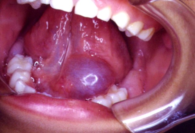 Primary Tuberculosis of Submandibular Gland Presenting as Dental Abscess