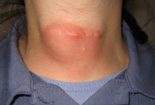 Asymptomatic Neck Mass as the Only Presenting Symptom of Advanced Prostate Cancer, a Case Report and Literature Review