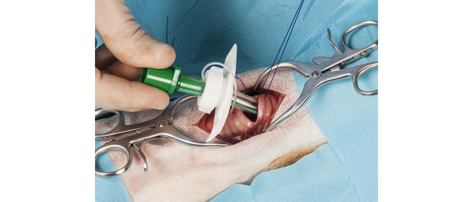 Quantitative Assessment of an Obstructive Sleep Apnea Patient Before and After Tracheostomy: A Case Study