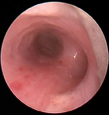 An Unusual Airway Foreign Body: A Cockroach in the Trachea