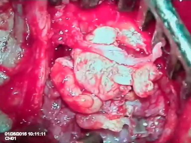 Langerhans Cell Histiocytosis in Temporal Bone: Case Report