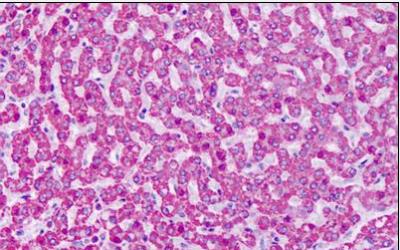 Large Cell Neuroendocrine Carcinoma of the Larynx: A Case Report and Review of Literature