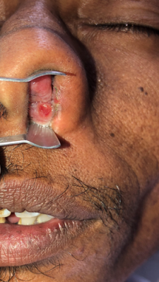 A Unilateral Protruding Nasal Mass
