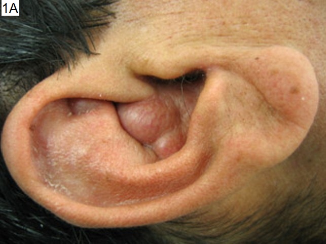 Unusual Ear Mass