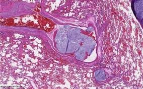 Fludarabine-
(C2-methylhydroxyphosphoramide)-
[anti-IGF-1R]: Synthesis and Selectively
Targeted Anti-Neoplastic Cytotoxicity
against Pulmonary Adenocarcinoma (A549)