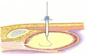 In Vitro Characterization of the Percutaneous Absorption of Lorazepam into Human Cadaver Torso Skin, Using the Franz Skin Finite Dose Models