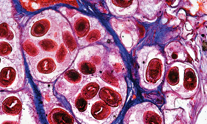 Mutation Occurrence in TP53 and Ctnnb1 Genes in Hepatocellular Carcinoma Associated with Echinococcus granulosus Infection