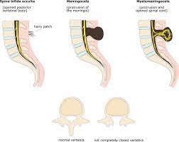 Myelomeningocele is a Severe form of Spina Bifida