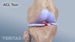 Anterior Cruciate Ligament Injury