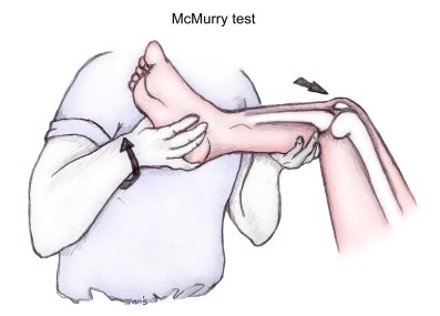 The McMurray’s Test-A Historical Perspective