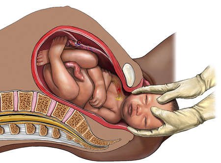 Physical Therapy Protocol for the Management of Obstetric Brachial Plexus Palsy