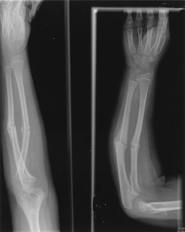 One Shot Too Many: Ulnar and Radial Stress Fracture in a Varsity Basketball Player