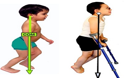 Effectiveness of Physiotherapy for Children with Spastic Diplegic Cerebral Palsy: A Case Report