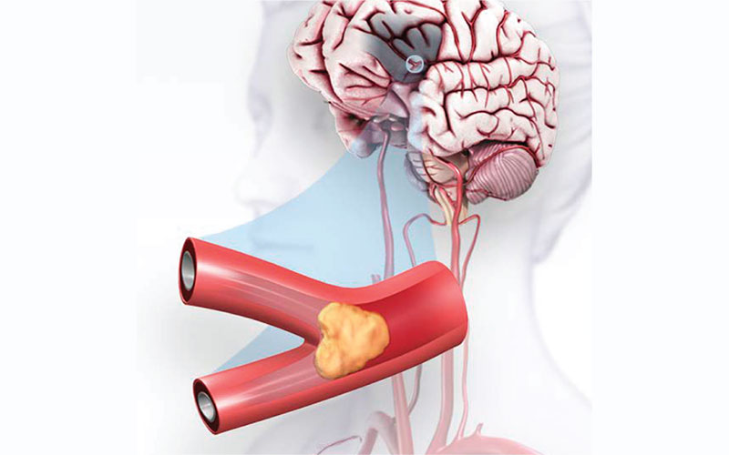 The Use of ICF in Physiotherapy Management for Patient with Ischemic Stroke: A Case Study