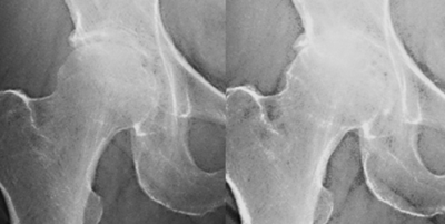 Narrative-based Medicine for Development of Home Exercise to Prevent Surgery in Hip Osteoarthritis: Consideration of Pericapsular Soft Tissue as a Pain Generator