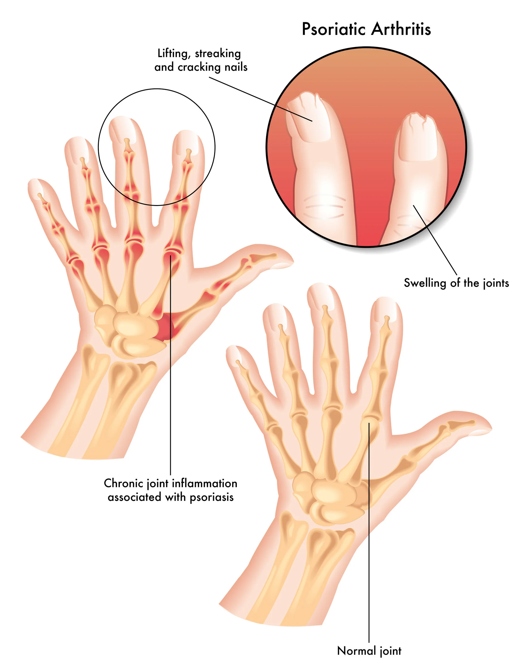 Case Report: Psoriatic Arthritis and Stem Cell Therapy