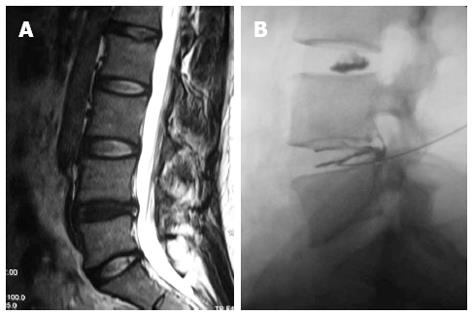 Intradiscal Injection of Dehydrated Human AmnionChorion Membrane for Treatment of Chronic Discogenic Low Back Pain: A Case Series
