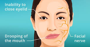 Case Report: Bellâ€™s Palsy and Stem Cell Therapy