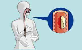 Regenerative Treatment Utilizing Epithelial Cell Sheets to Oesophageal Ulcer After Endoscopic Submucosal  Analyzation