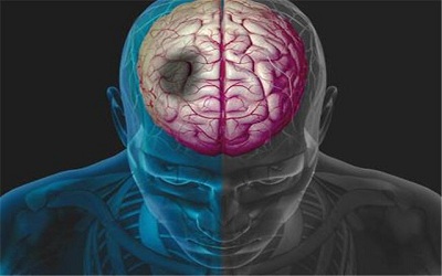 TGF-β Signaling in Brain Scarring after Ischemic Stroke