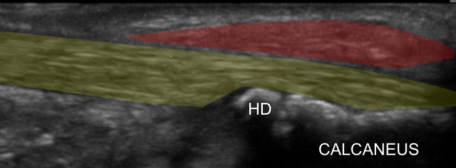 Chronic Superficial Achilles Bursitis Treated with Percutaneous Bursectomy and Platelet-Rich Plasma Injection: A Case Report