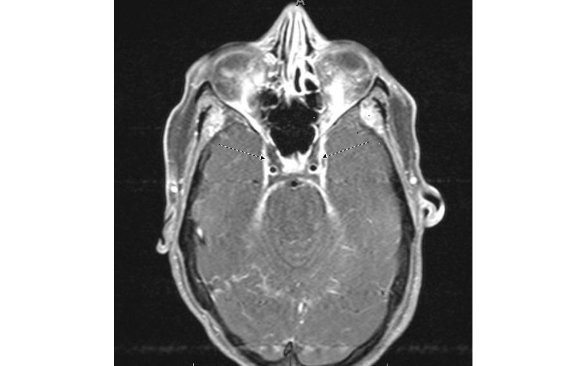 Bilateral cavernously nerve injury