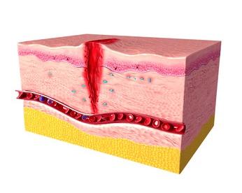 Wound healing By Regenerative Medicine