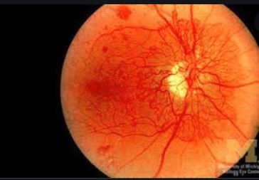 Induced Neovasculariziation Formation In Ischemic Myocardium