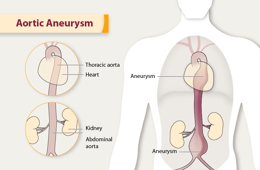 Stomach Influence Therapeutic Effects on Aortic Aneurysm