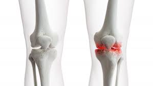 Safety, Efficacy and Short-Term Results with Intra-Articular Bone Marrow Concentrate for Arthritic Knee Pain