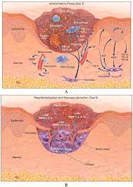 Rapid and Proper Healing by Microparticulate Systemsis With Treatment of Skin Wounds