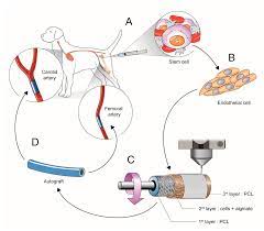 Remedial Impact of Autologous Bone Marrow for Microorganism Activation Joined with Against Infective Treatment on Moyamoya Disease