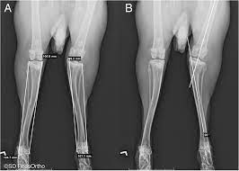Creature Groundwork for Rabbit Model of Physeal Injury in the Evaluation of Regenerative Medicine