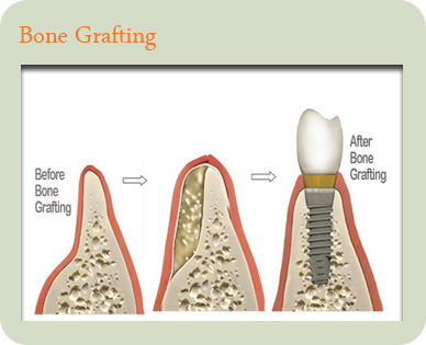 Novel Nanocrystalline Hydroxyapatite for Bone
Regeneration