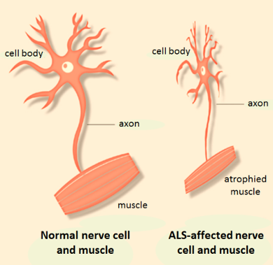 Stem Cell Therapy for Amyotrophic Lateral Sclerosis:Yesterday, Today and Tomorrow