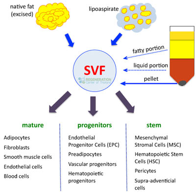 Use of Autologous Adipose- Derived Stromal Vascular Fraction to Treat Osteoarthritis of the Knee: A Feasibility and Safety Study