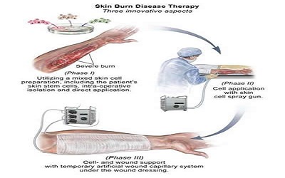 A Decade after Foetal Skin Progenitor Cell Therapy in Pediatric Burn Treatment