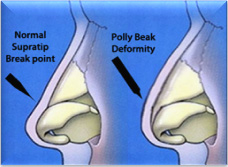 A combined use of Chondrocytes Micro Grafts (CMG) Mixed with Platelet Rich Plasma (PRP) in Patients Affected by Pinch Nose Deformity