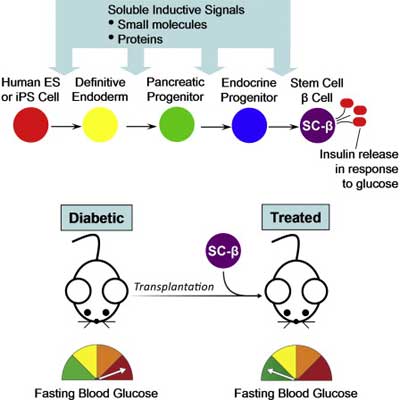 Human Peripheral Blood Stem Cells and The Glycemic Index Diet can be a Solution to Diabetes Mellitus Type 2