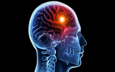 Intravenous Injection of Autologous Bone Marrow Derived Mononuclear Cells in Ischemic Stroke Patients in Iraq