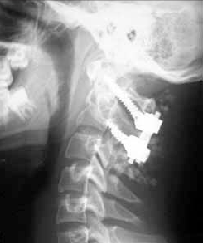 Utility of Laminar Fiducials for Registration to Maximize Safety of C2 Pedicle Screw Placement for Atlantoaxial Instability due to Os Odontoideum in Down Syndrome: A Technical Note