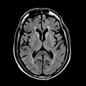 Fatal Hyperammonemic Encephalitis Following Gastric Bypass