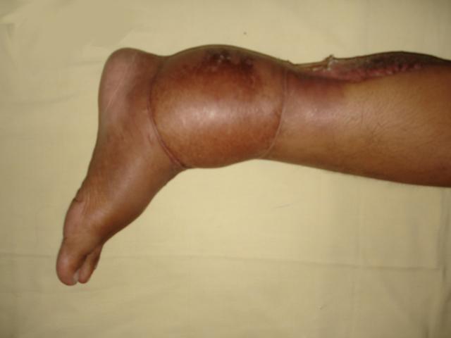 Surgery of Soft Tissue Limb Sarcomas in An African Cancer Center