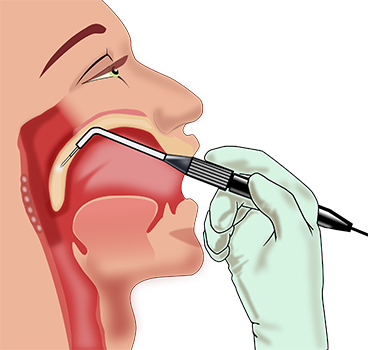 Outcomes of Impaction of Unusual Foreign Bodies in the Aero-digestive Tracts